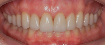 Módszerek megszüntetésére fogíny mosoly - Department of Dentistry atribeaute Clinique (mosolyog) Módszerek megszüntetésére fogíny mosoly - Department of Dentistry atribeaute clinique