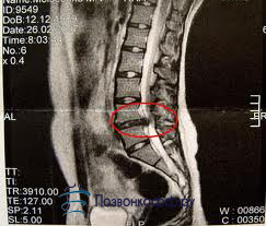 Intervenția lombară a coloanei vertebrale și consecințele acesteia