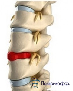 Міжхребцева грижа поперекового відділу симптоми і наслідки