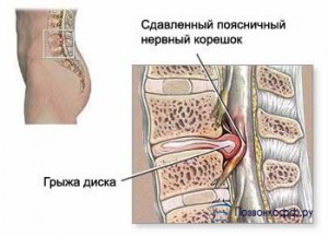 Intervenția lombară a coloanei vertebrale și consecințele acesteia