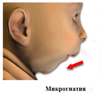 Micrognatia și microgenia subdezvoltare a maxilarului superior și inferior