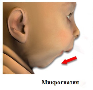 Micrognathia microgeny és az elmaradottság a felső és alsó állkapocs