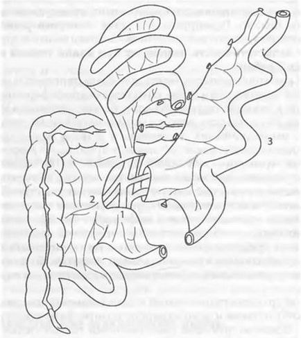 ureterului; Artera 8-renale; Vena 9-renală; 10-fragment al duodenului donatorului