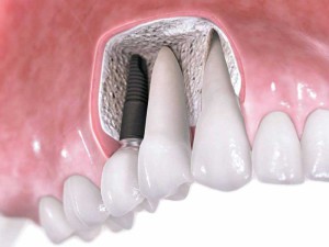 Fie că este posibil să faci sau să faci mrt cu implanturi de dinți și metal koronkami