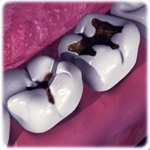 Folk Remedies for Caries - Enciclopedia de Medicină Tradițională