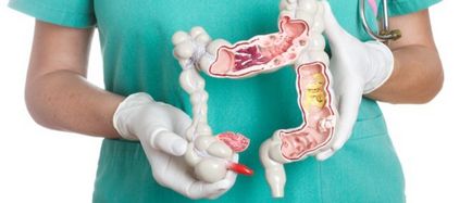 Curățarea gutului cu hidrocolonoterapie