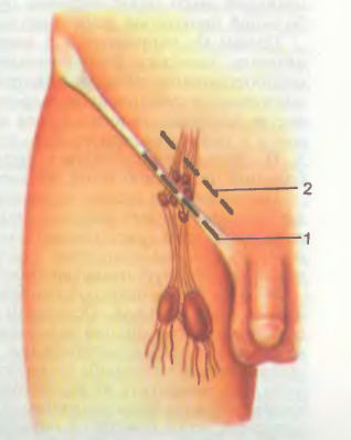 Tratamentul operativ al venelor varicoase ale membrelor inferioare - abstract, pagina 2