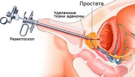 Chirurgie pentru a elimina efectele adenomului prostatic, recenzii