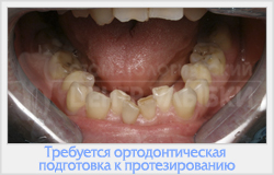 Ортодонтична підготовка до протезування