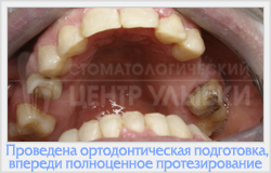 Ортодонтична підготовка до протезування