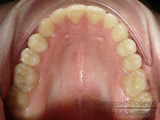 Ортодонтична підготовка до протезування зубів (никита д