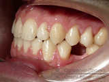 Preparat ortodontic pentru proteze dentare (nikita d