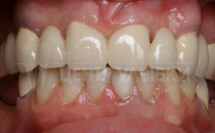 Ортодонтична підготовка до протезування
