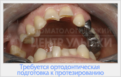 Preparat ortodontic pentru proteze