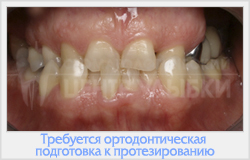 Preparat ortodontic pentru proteze