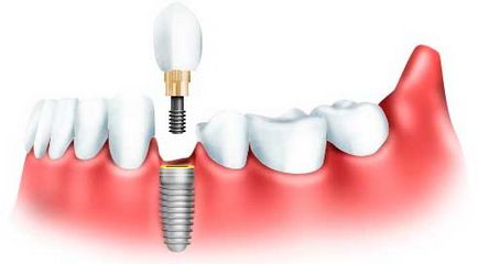Основні види зубного протезування і їх характеристики