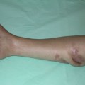 Osteomyelitis tünetei és kezelése