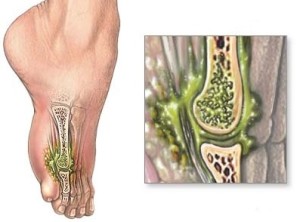 Osteomyelitis tünetei és kezelése