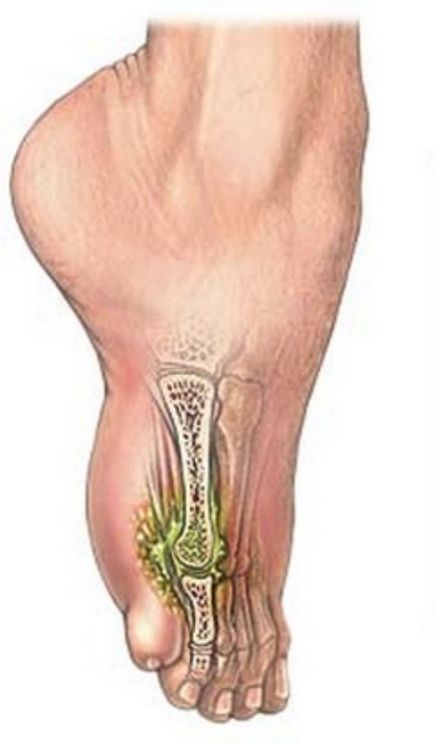 Osteomielita la picioare