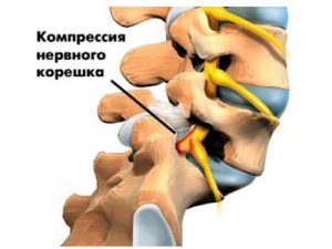 Osteocondroza cu tratament simptomatic al sindromului radicular