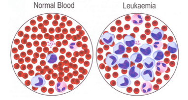 Prognoze leucemice acute la copii și adulți