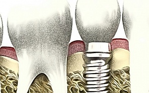 Albirea dinților 1