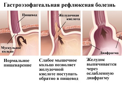 Відрижка і нудота причини, стравохід wiki