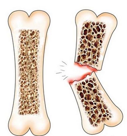 Fracturile oaselor