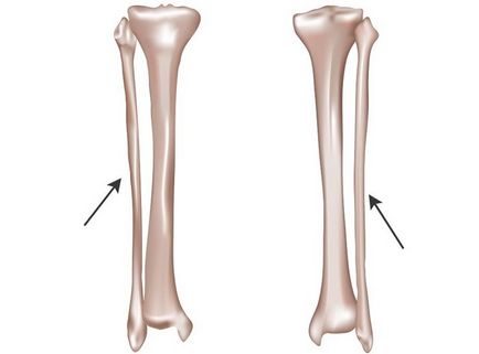 Törés fibula kezelés és a rehabilitáció, a séta a leadott - egészségesen élni