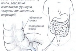 Peritonita cu apendicită