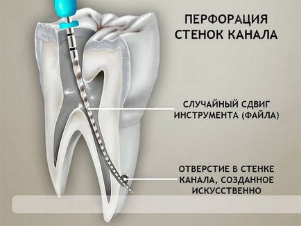 Töltőanyag elhagyta a csatornát, mit kell tenni, a következmények