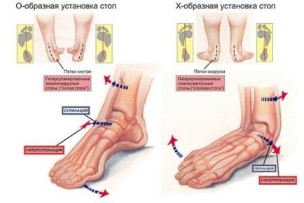 Tipuri de picior și cauze de deformare a picioarelor