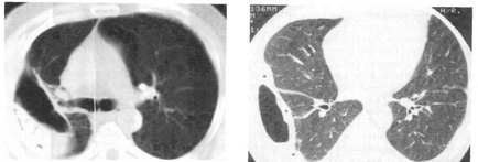 Pneumotorax, tomografie computerizată