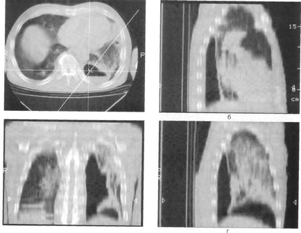 Pneumotorax, tomografie computerizată