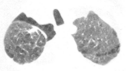 Pneumotorax, tomografie computerizată