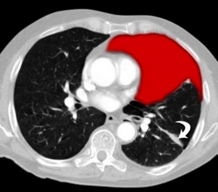 Pneumothorax a röntgen veszélyre utaló jelek szempontjából, az alternatív