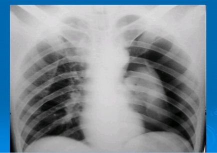 Pneumothorax a röntgen veszélyre utaló jelek szempontjából, az alternatív
