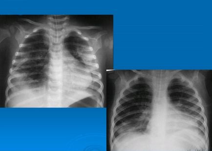 Pneumothorax a röntgen veszélyre utaló jelek szempontjából, az alternatív