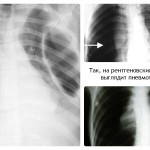 Pneumotorax pe descrierea și fotografia radiografică