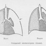 Pneumotorax pe descrierea și fotografia radiografică