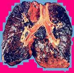 Чому болять легені від куріння