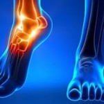 Poszttraumás artrózis a bokaízület kezelésére (közös) Poszttraumás arthrosis boka kezelés