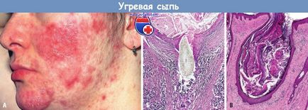 Cauze și mecanisme de dezvoltare a acneei