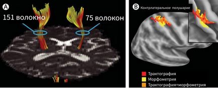 Căile de circulație ale creierului și imagistica prin difuzie-tensor (dtw, dti)