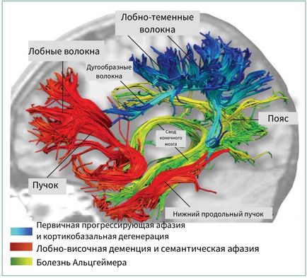 Căile de circulație ale creierului și imagistica prin difuzie-tensor (dtw, dti)