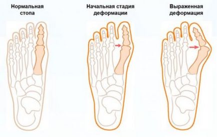 Зростає кісточка на нозі біля великого пальця - що робити в першу чергу