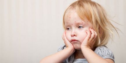 A reakció a vakcina kanyaró-mumpsz-rubeola - normális tünetek az oltás után, és jeleket