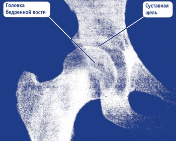 Roentgenodiagnosisul coxartrozei este cea mai frecventă eroare