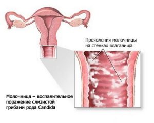 Найефективніші свічки від молочниці і недорогі