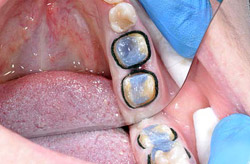 Самоадгезівние композитні цементи в практиці ортопедичної стоматології